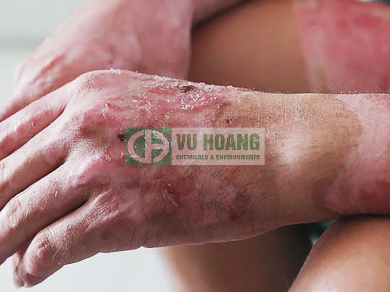 xut-gay-an-mon-da-khi-tiep-xuc