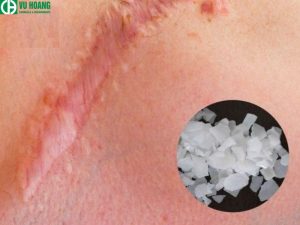 NaOH gây bỏng trên da