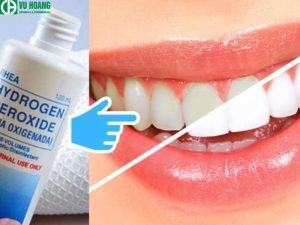 Công dụng của oxy già trong quá trình làm trắng răng