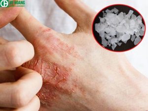 Cẩn thận khi sử dụng xút NaOH ăn da