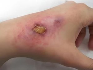 Vết thương ngoài da không nên dùng Oxy già để rửa để tránh lâu lành