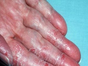 Xút ăn da rất nguy hiểm