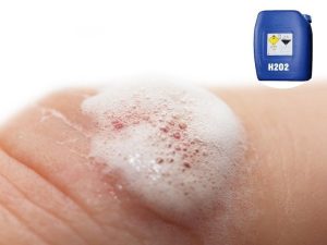 Hình ảnh vết thương sử dụng oxy già để sát trùng