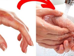 Rửa vết bỏng axit dưới vòi nước