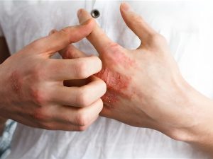 Thuốc tím có nhiều công dụng trong điều trị bệnh lý da liễu